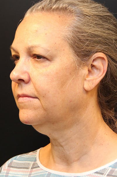 Facelift Before & After Gallery - Patient 172881936 - Image 1