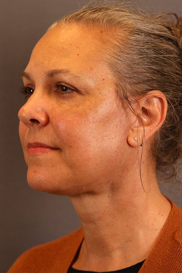 Facelift Before & After Gallery - Patient 172881936 - Image 2