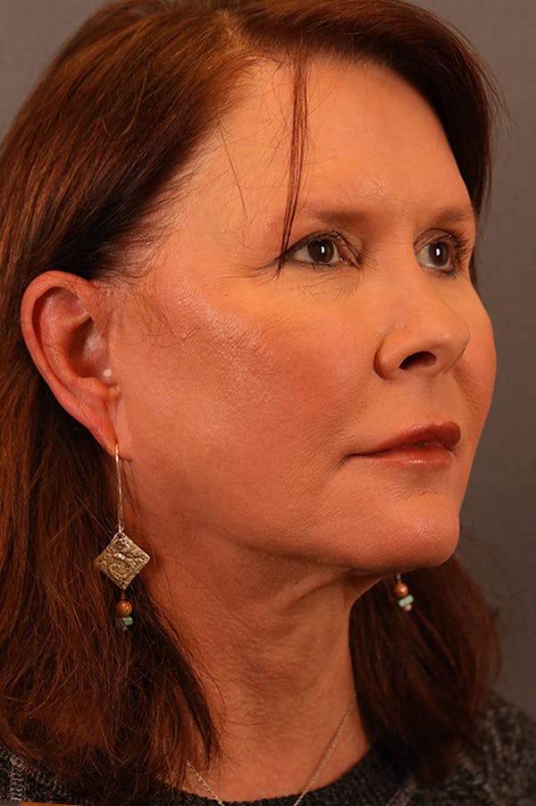 Facelift Before & After Gallery - Patient 172881921 - Image 1