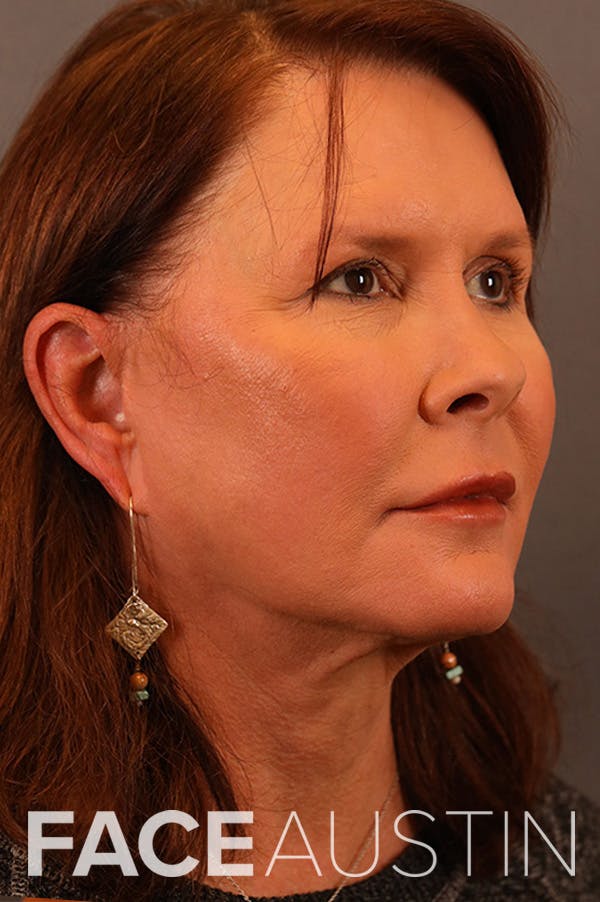 Facelift Before & After Gallery - Patient 172881921 - Image 1