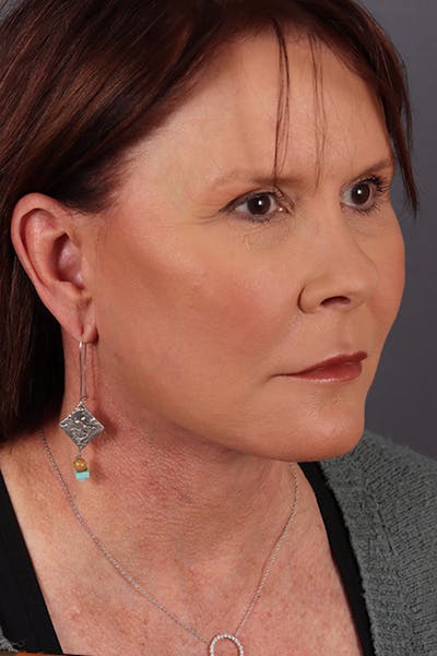 Facelift Before & After Gallery - Patient 172881921 - Image 2