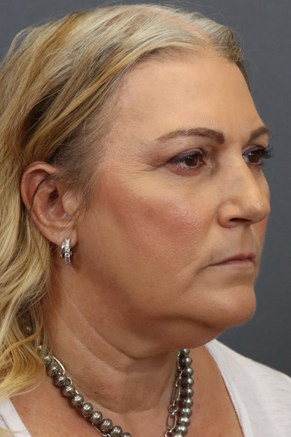 Facelift Before & After Gallery - Patient 172881925 - Image 1