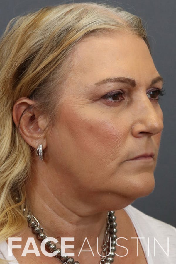 Facelift Before & After Gallery - Patient 172881925 - Image 1