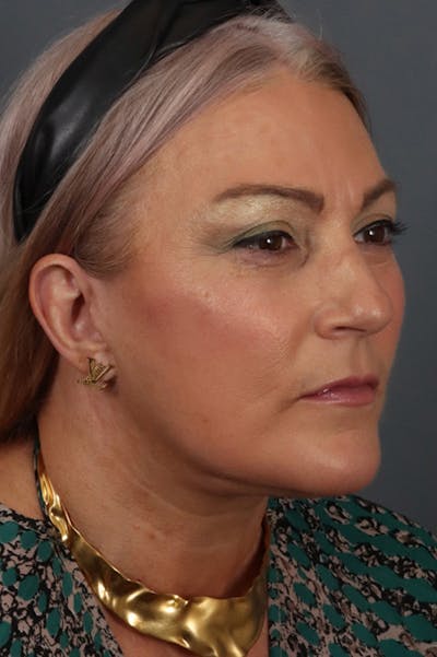Facelift Before & After Gallery - Patient 172881925 - Image 2