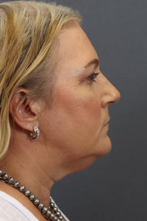 Neck Lift & Facelift Surgery