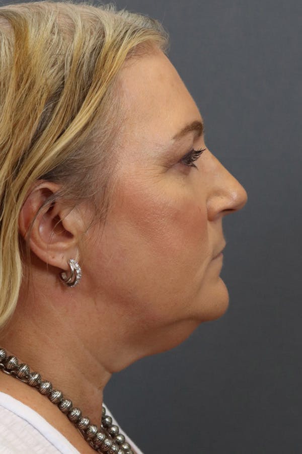 Facelift Before & After Gallery - Patient 172881925 - Image 3