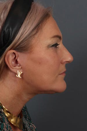 Neck Lift & Facelift Surgery