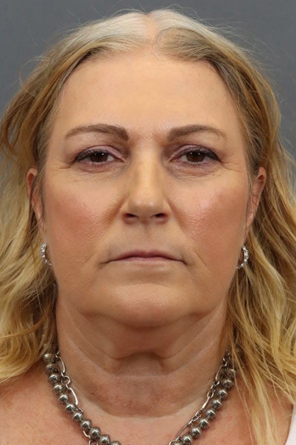 Facelift Before & After Gallery - Patient 172881925 - Image 5
