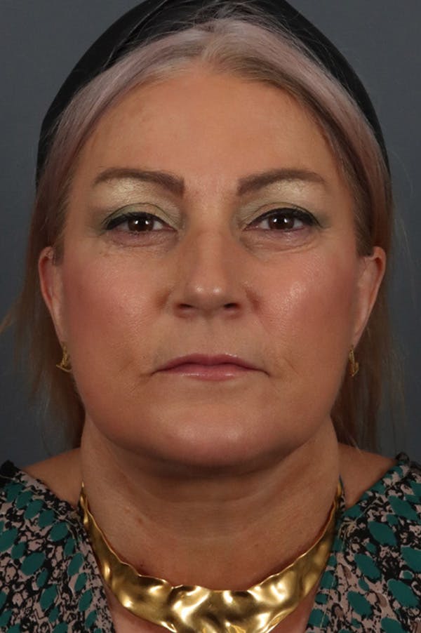 Facelift Before & After Gallery - Patient 172881925 - Image 6
