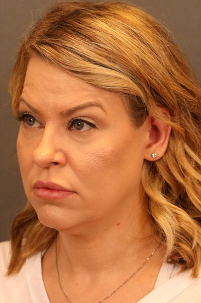 Facelift Before & After Gallery - Patient 172881927 - Image 1