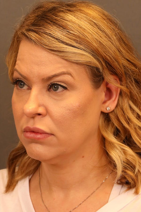 Facelift Before & After Gallery - Patient 172881927 - Image 1