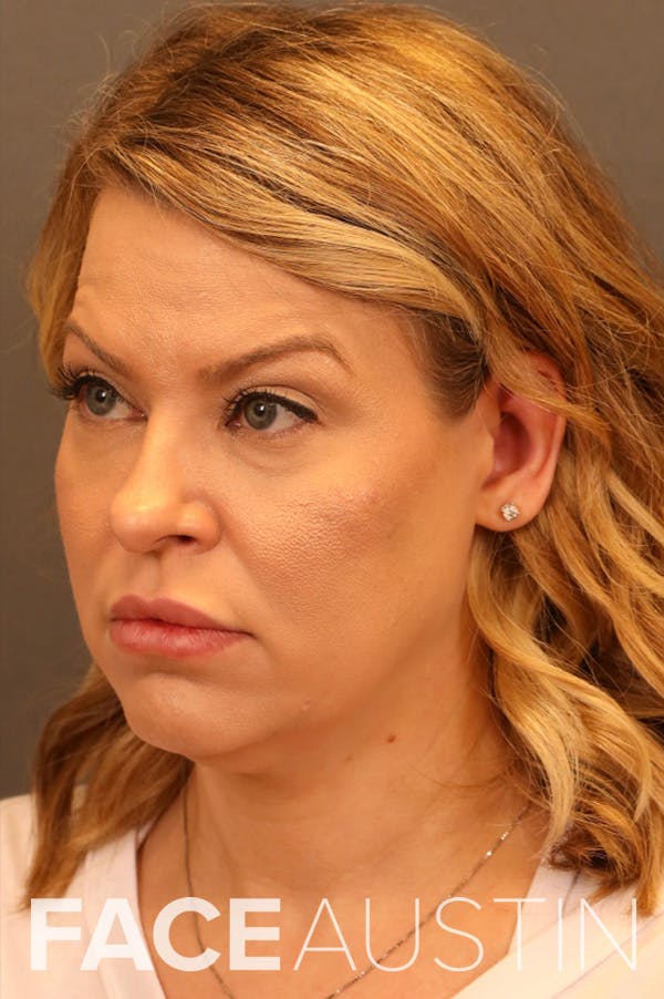 Facelift Before & After Gallery - Patient 172881927 - Image 1