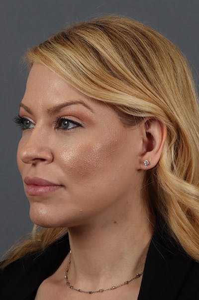 Facelift Before & After Gallery - Patient 172881927 - Image 2