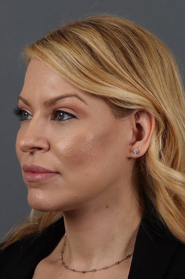 Facelift Before & After Gallery - Patient 172881927 - Image 2