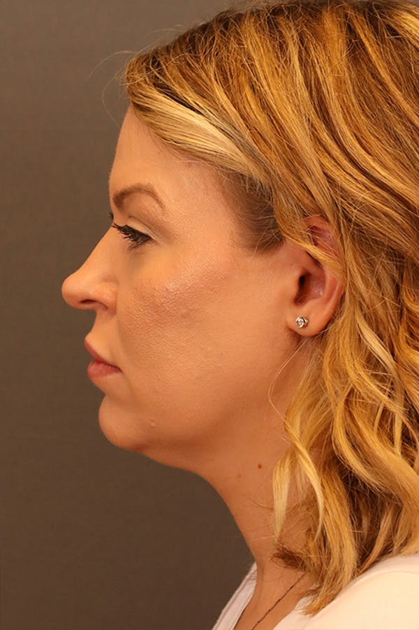 Facelift Before & After Gallery - Patient 172881927 - Image 3