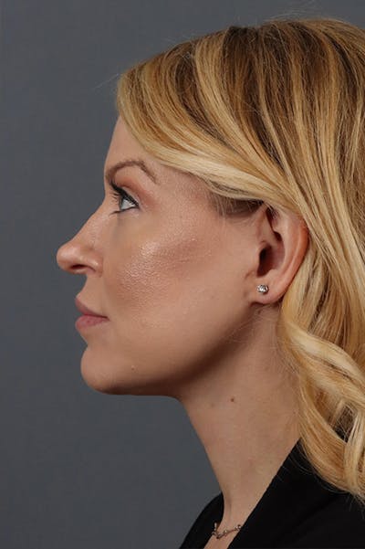 Facelift Before & After Gallery - Patient 172881927 - Image 4