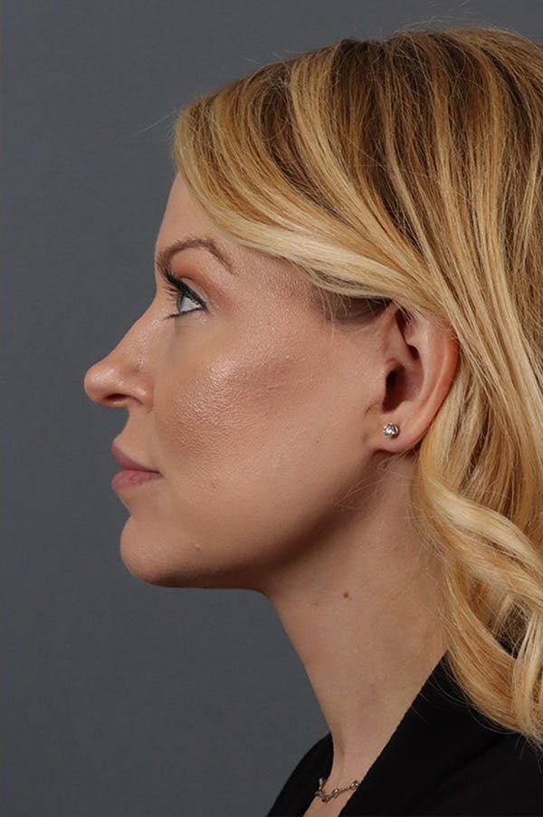 Facelift Before & After Gallery - Patient 172881927 - Image 4
