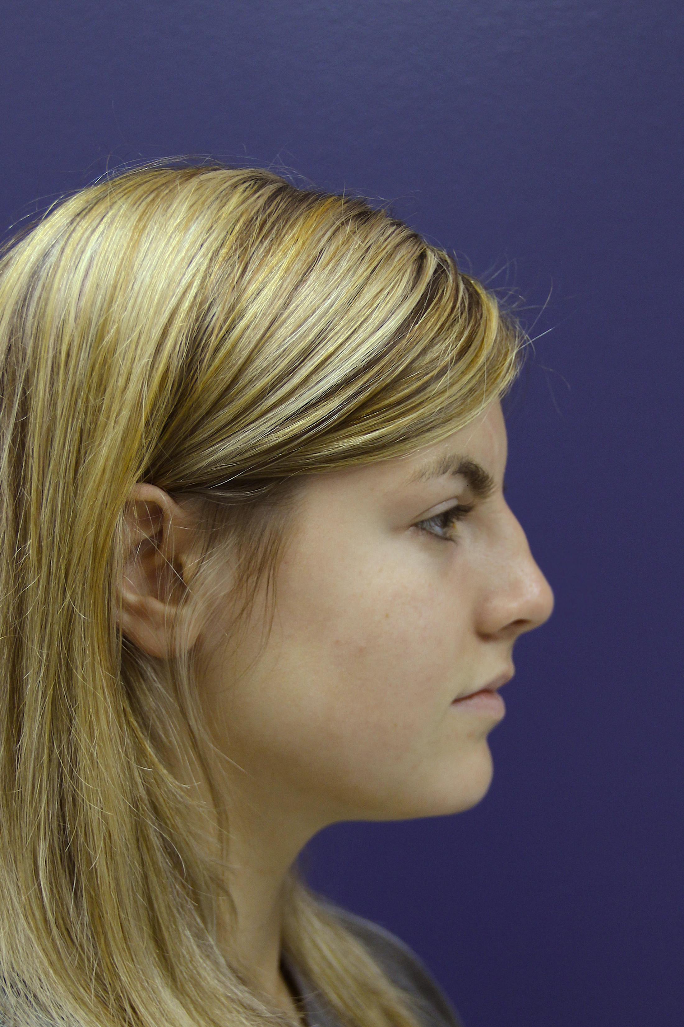 Rhinoplasty Before & After Gallery - Patient 14969442 - Image 3