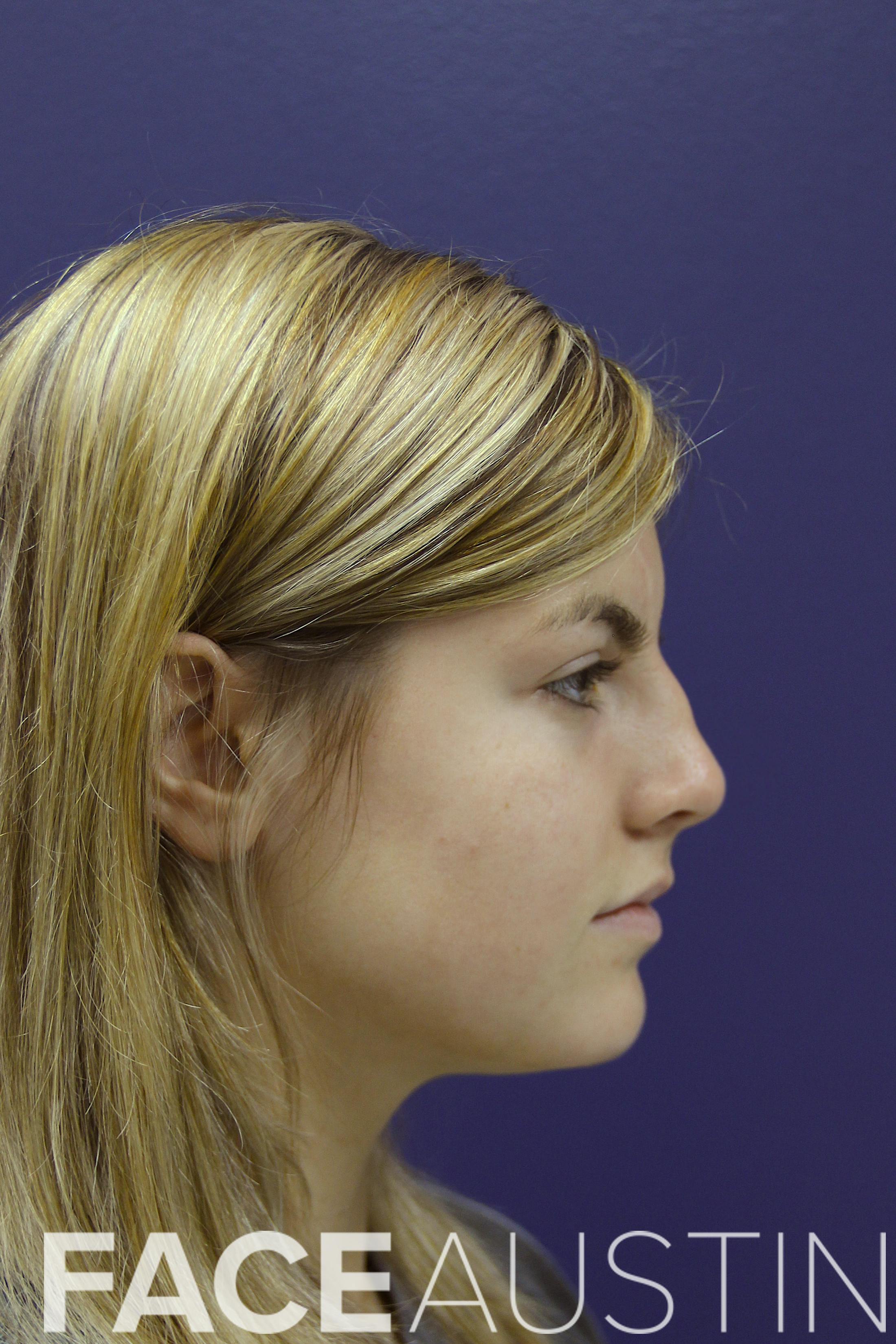 Rhinoplasty Before & After Gallery - Patient 14969442 - Image 1