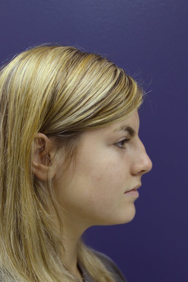 Rhinoplasty Before & After Gallery - Patient 14969442 - Image 3