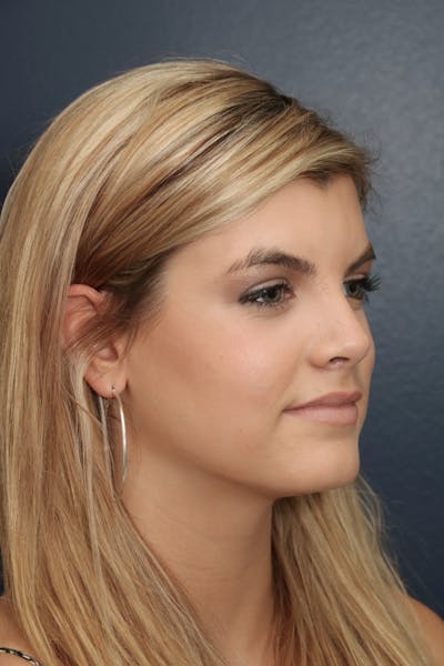 Rhinoplasty Before & After Gallery - Patient 14969442 - Image 2