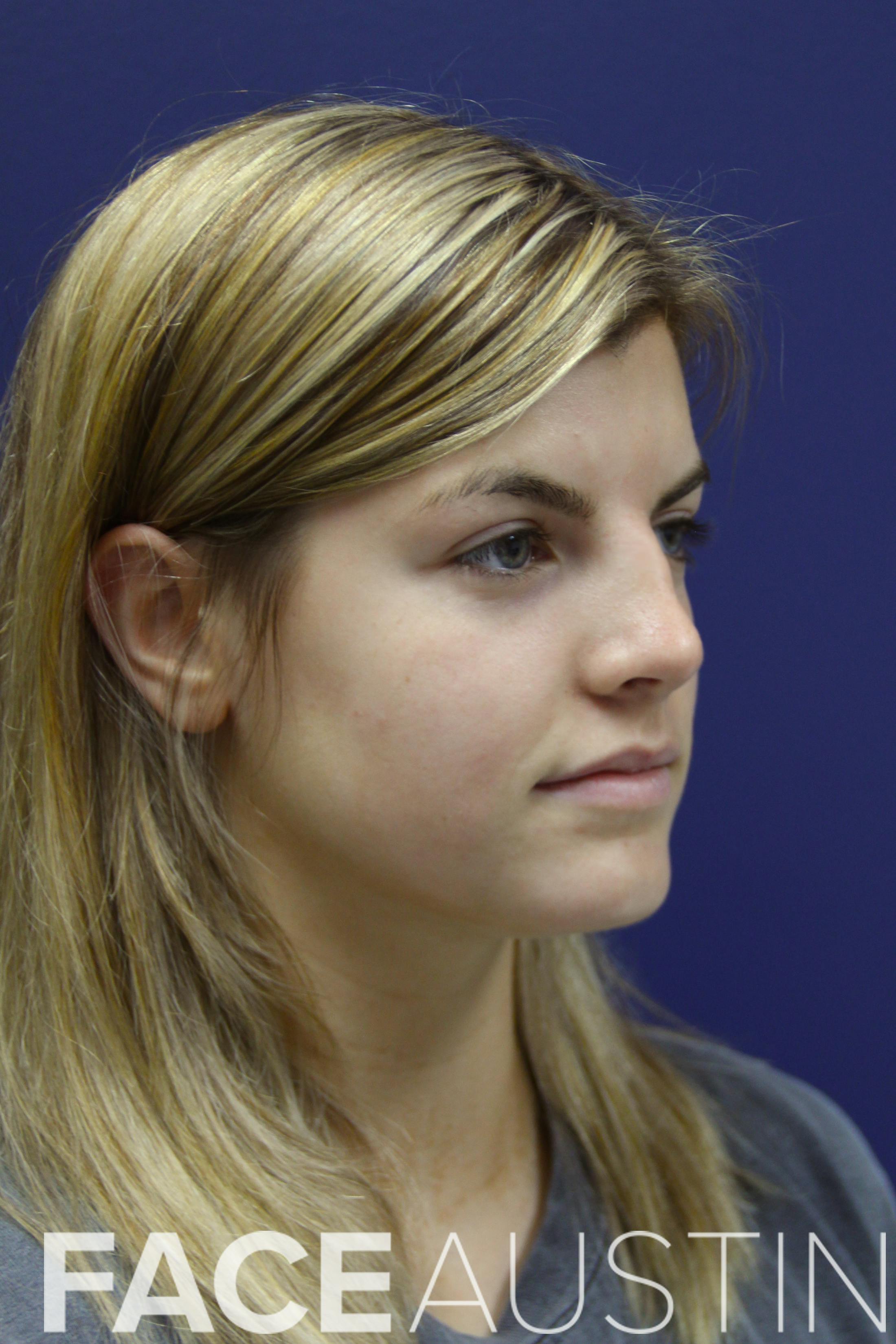 Rhinoplasty Before & After Gallery - Patient 14969442 - Image 1