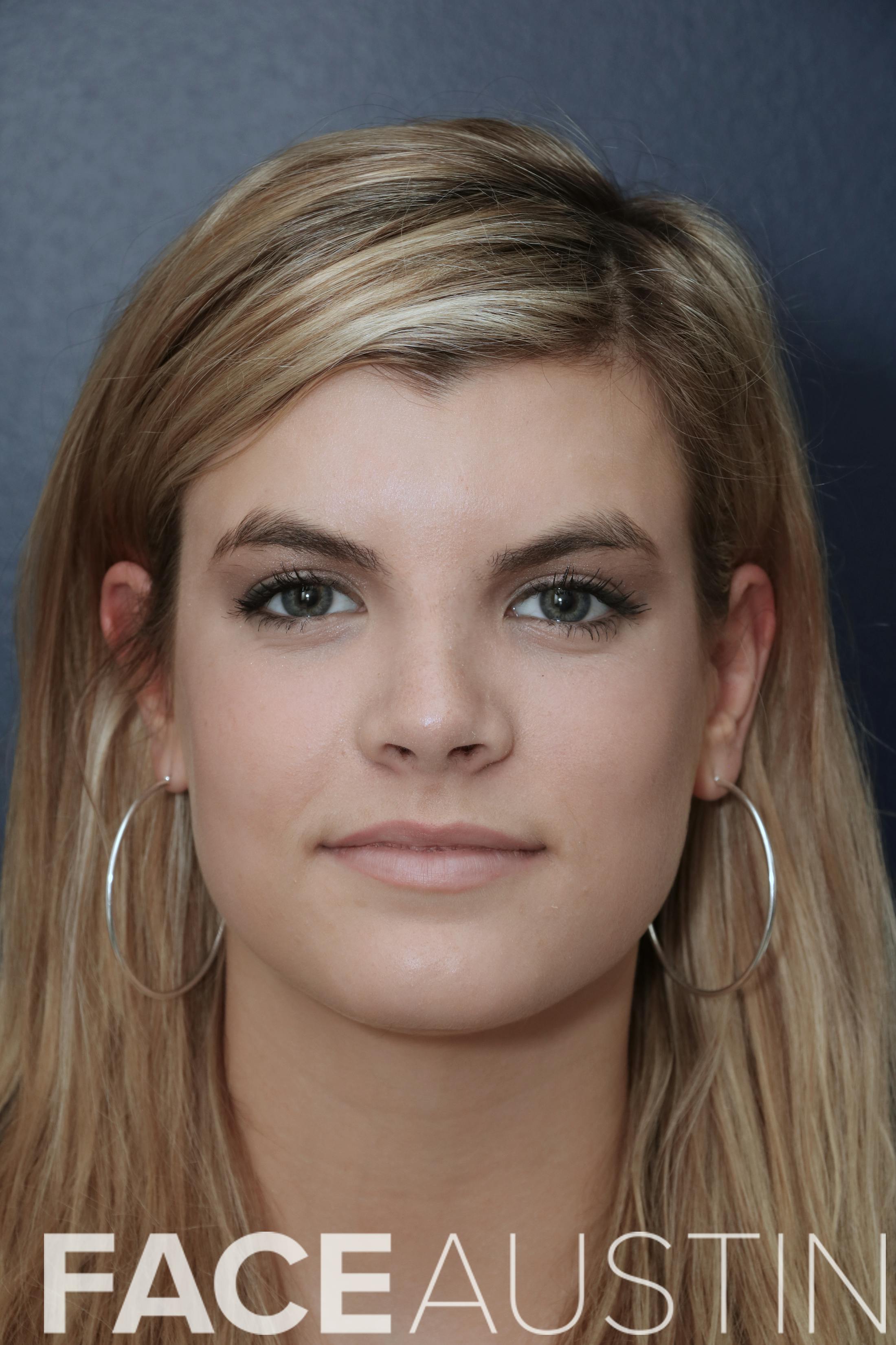 Rhinoplasty Before & After Gallery - Patient 14969442 - Image 6