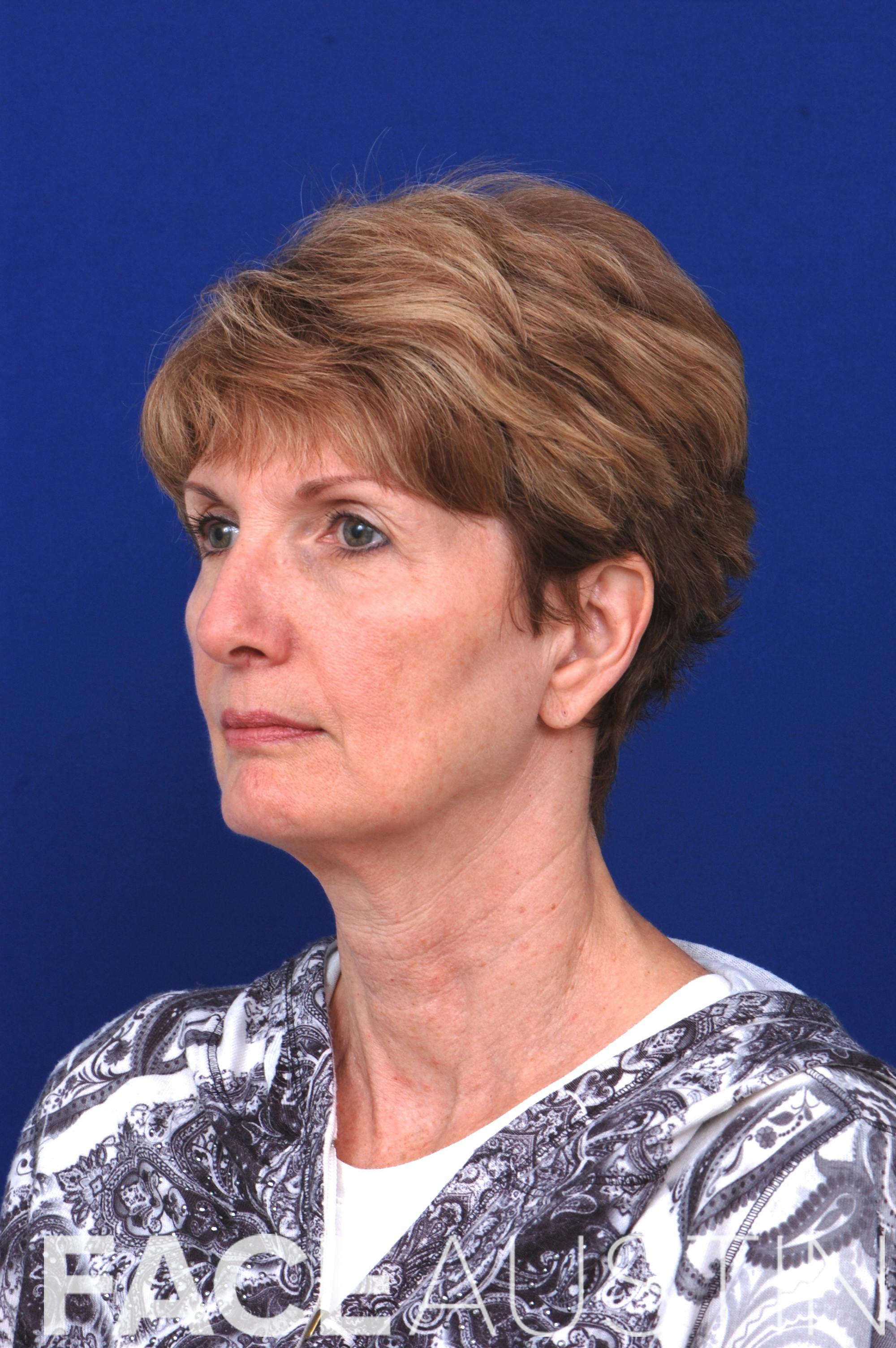 Rhinoplasty Before & After Gallery - Patient 14969441 - Image 1