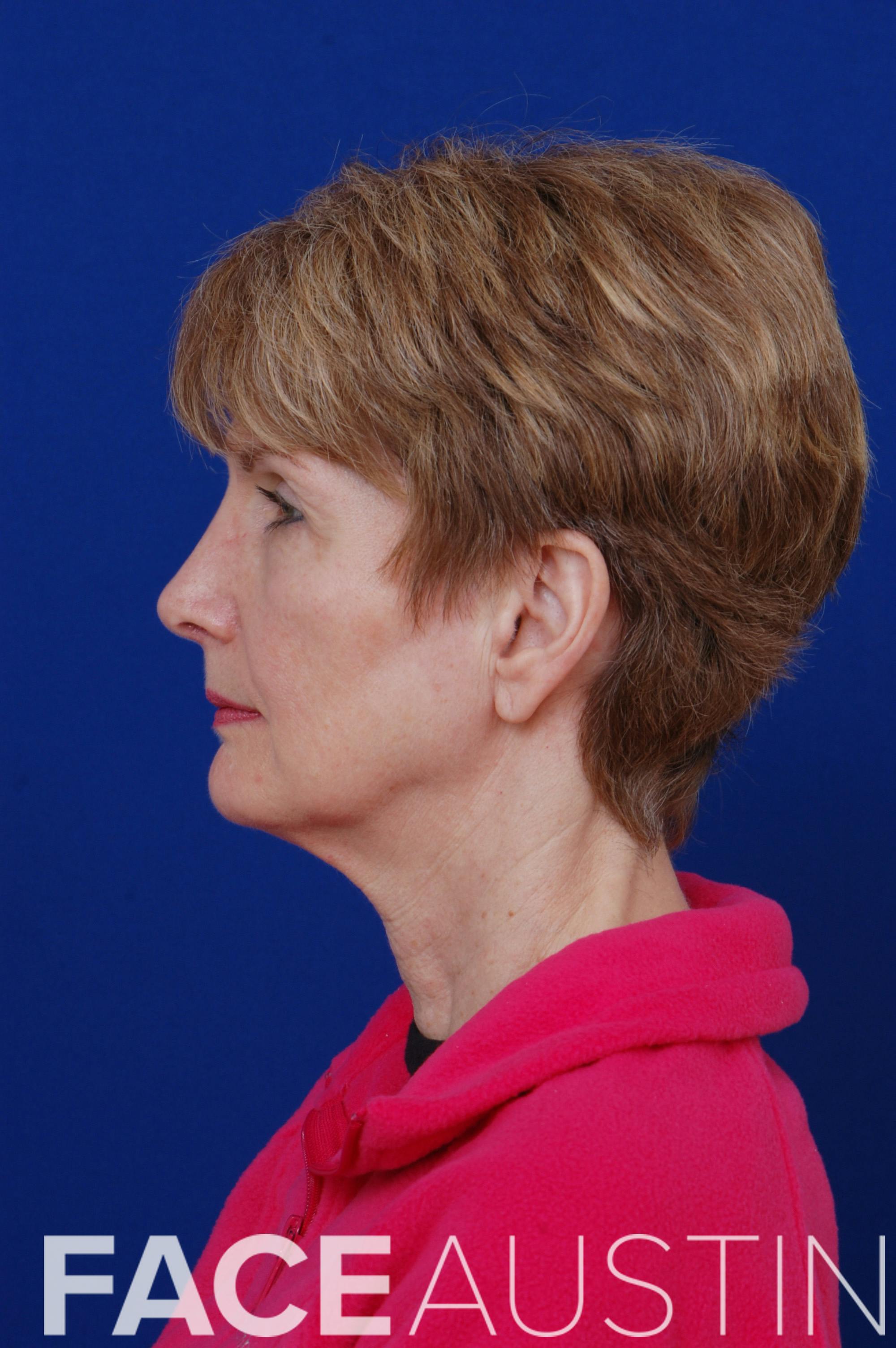 Rhinoplasty Before & After Gallery - Patient 14969441 - Image 6