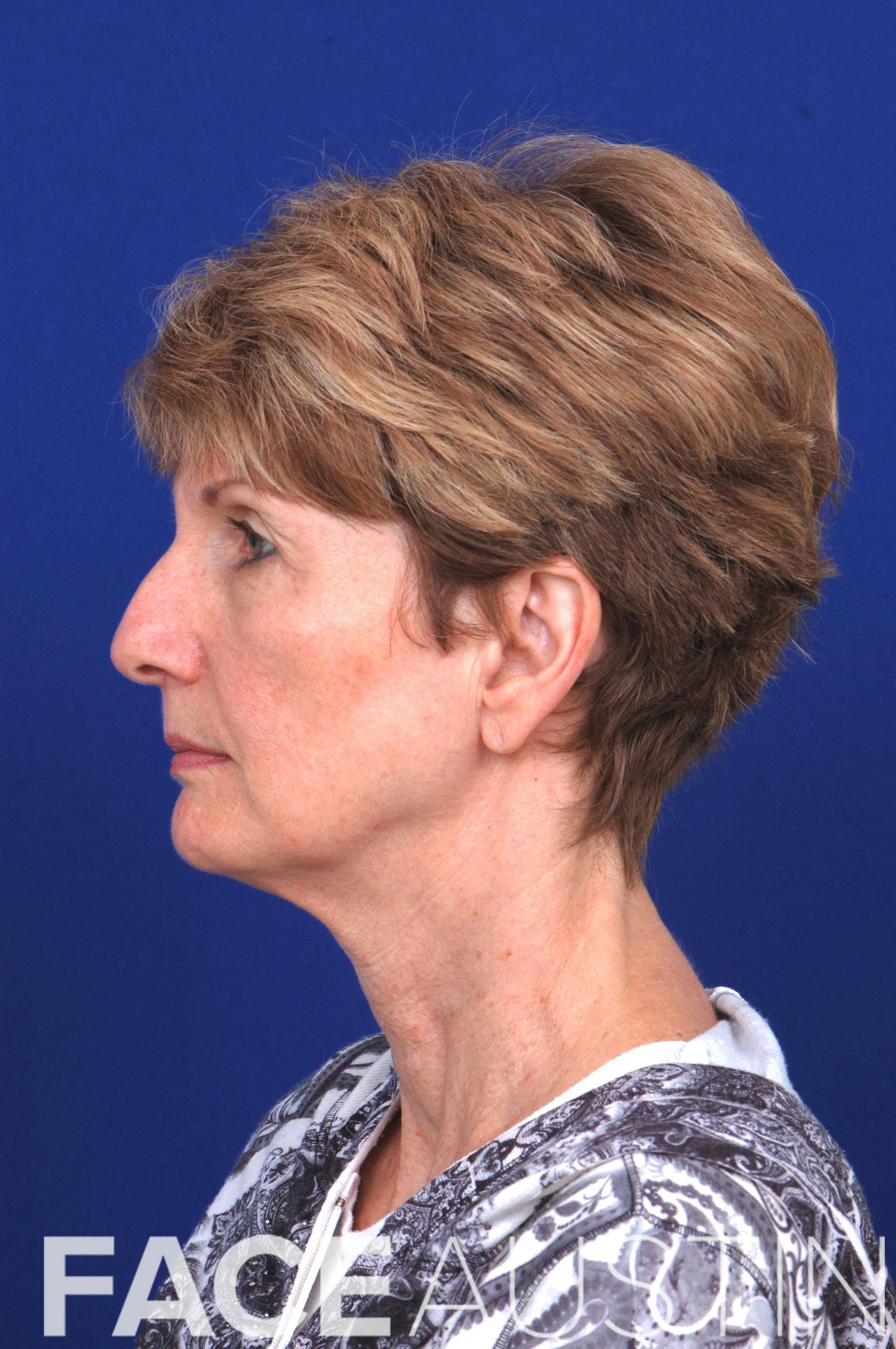 Rhinoplasty Before & After Gallery - Patient 14969441 - Image 1