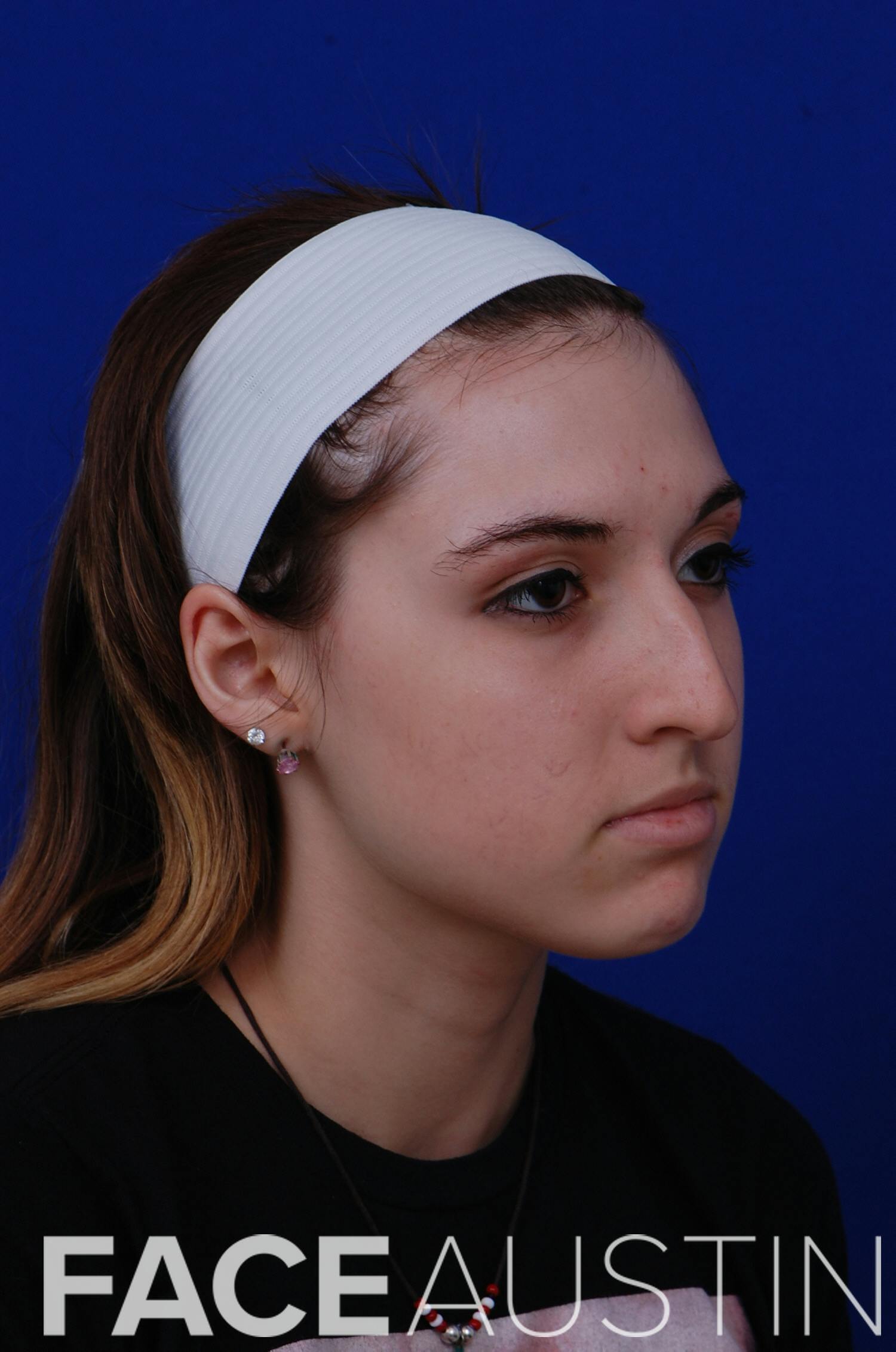 Rhinoplasty Before & After Gallery - Patient 14969404 - Image 1