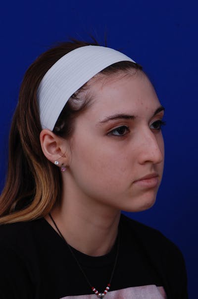 Rhinoplasty Before & After Gallery - Patient 14969404 - Image 1