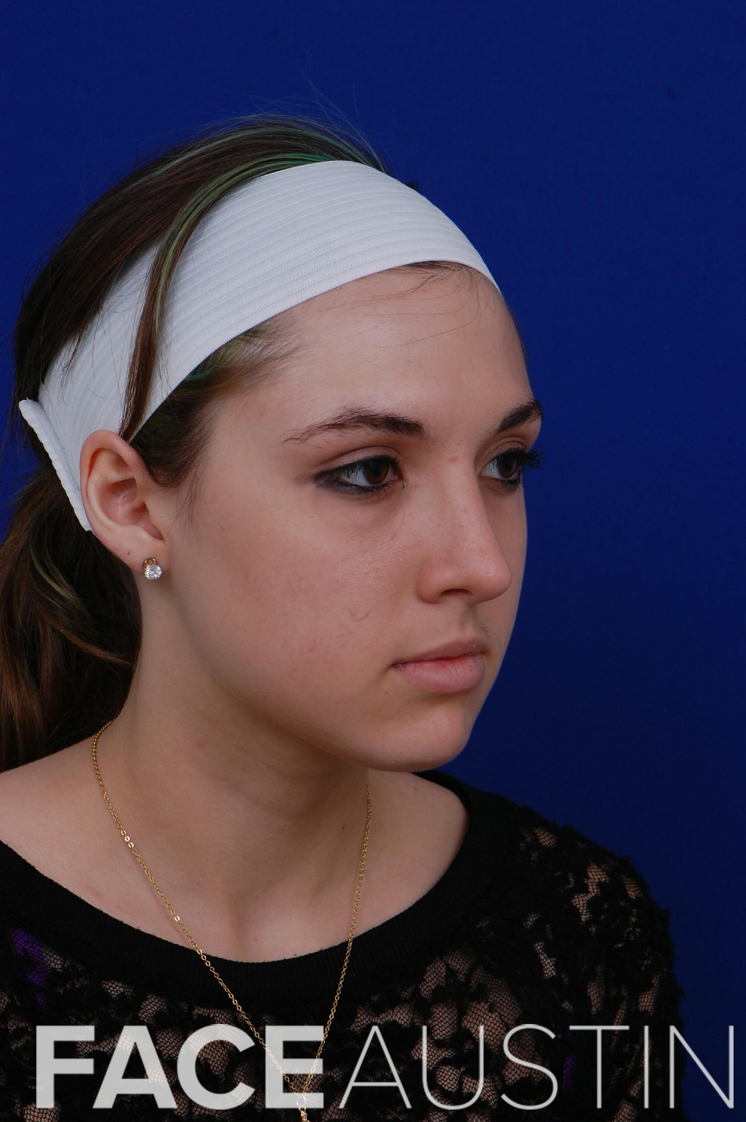 Rhinoplasty Before & After Gallery - Patient 14969404 - Image 2