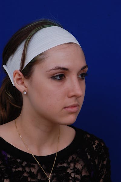 Rhinoplasty Before & After Gallery - Patient 14969404 - Image 2