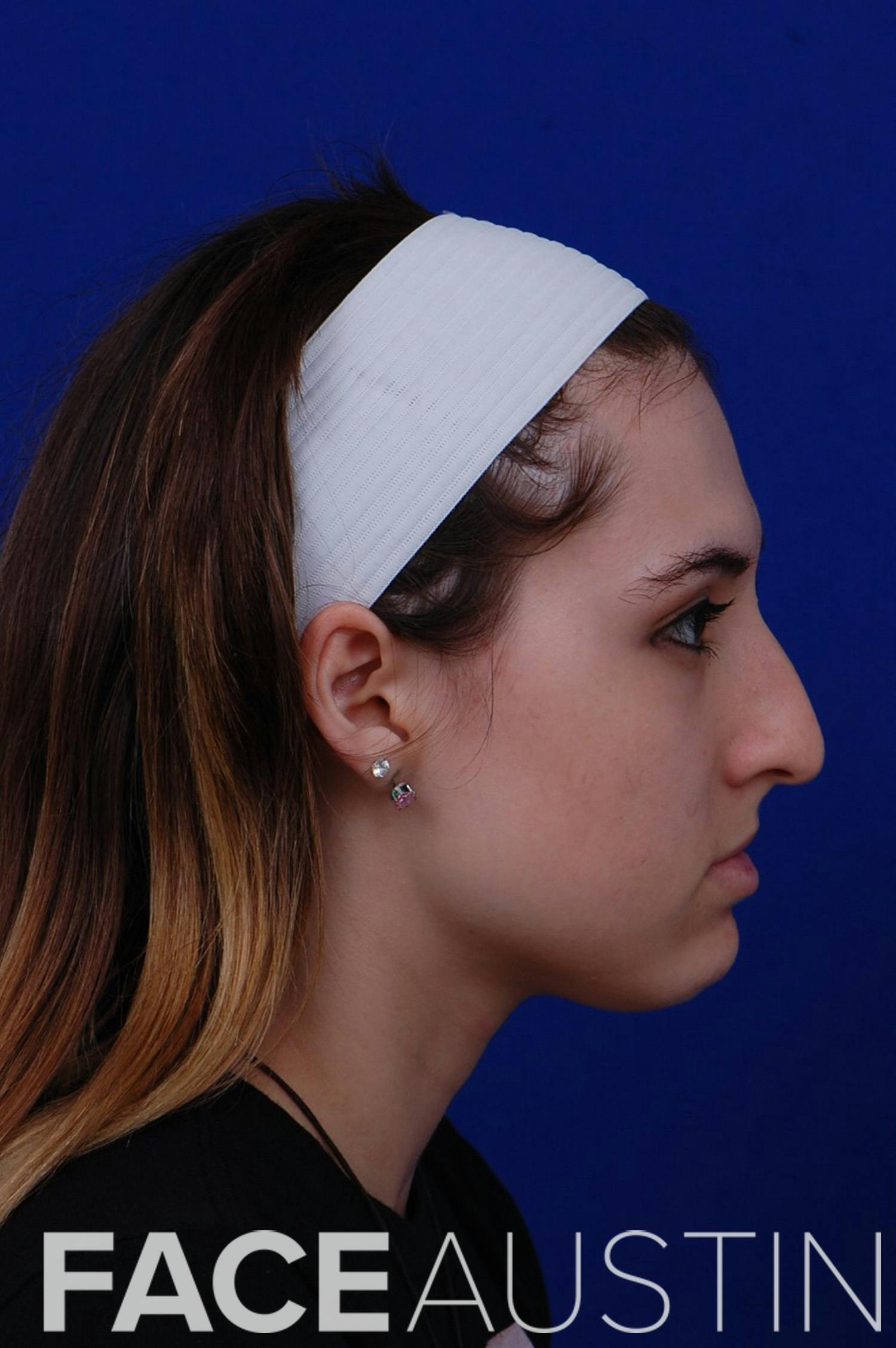 Rhinoplasty Before & After Gallery - Patient 14969404 - Image 1