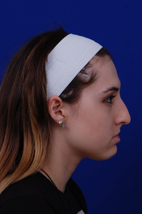 Rhinoplasty Before & After Gallery - Patient 14969404 - Image 3
