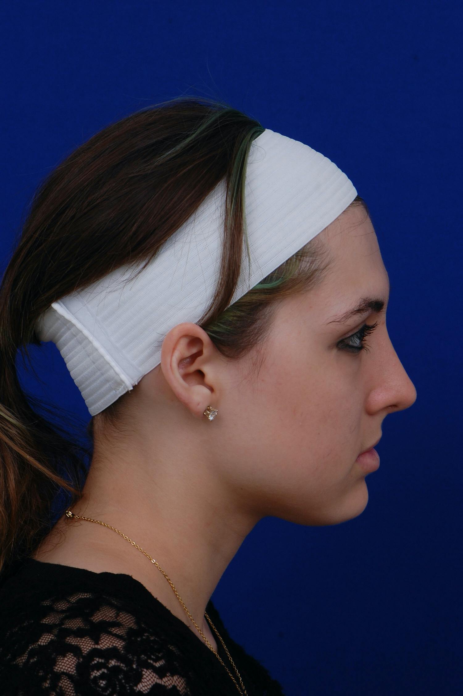 Rhinoplasty Before & After Gallery - Patient 14969404 - Image 4