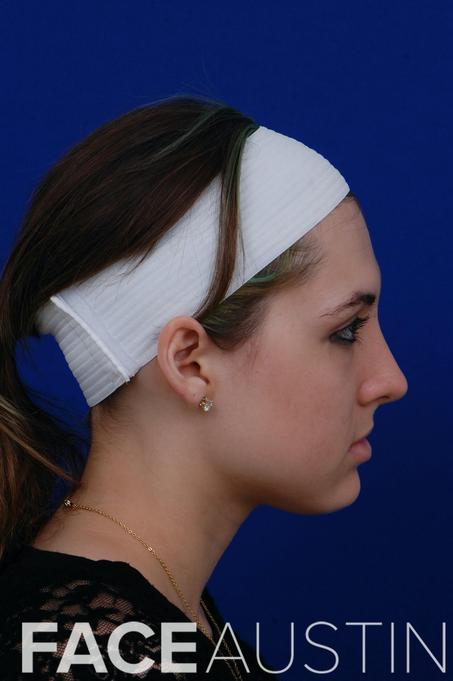Rhinoplasty Before & After Gallery - Patient 14969404 - Image 4