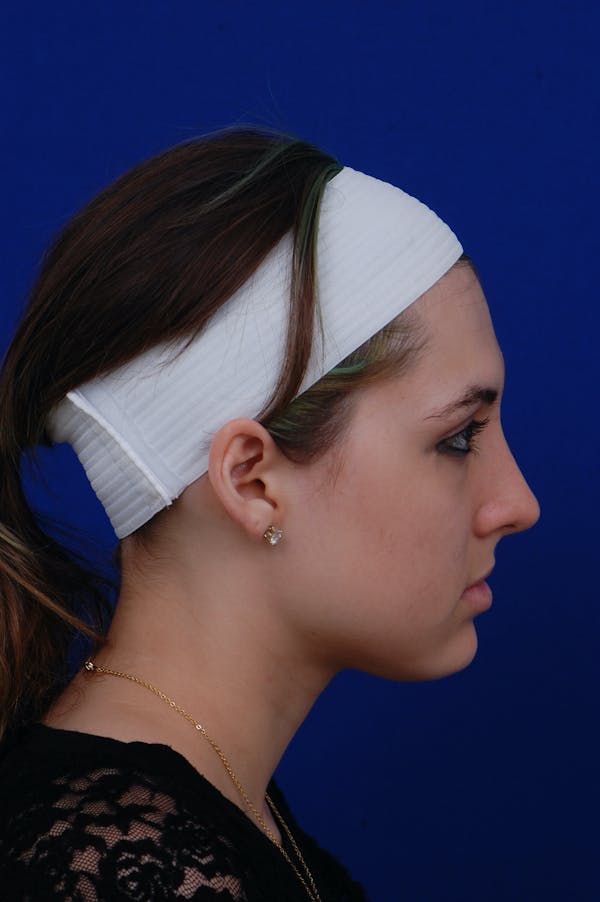 Rhinoplasty Before & After Gallery - Patient 14969404 - Image 4