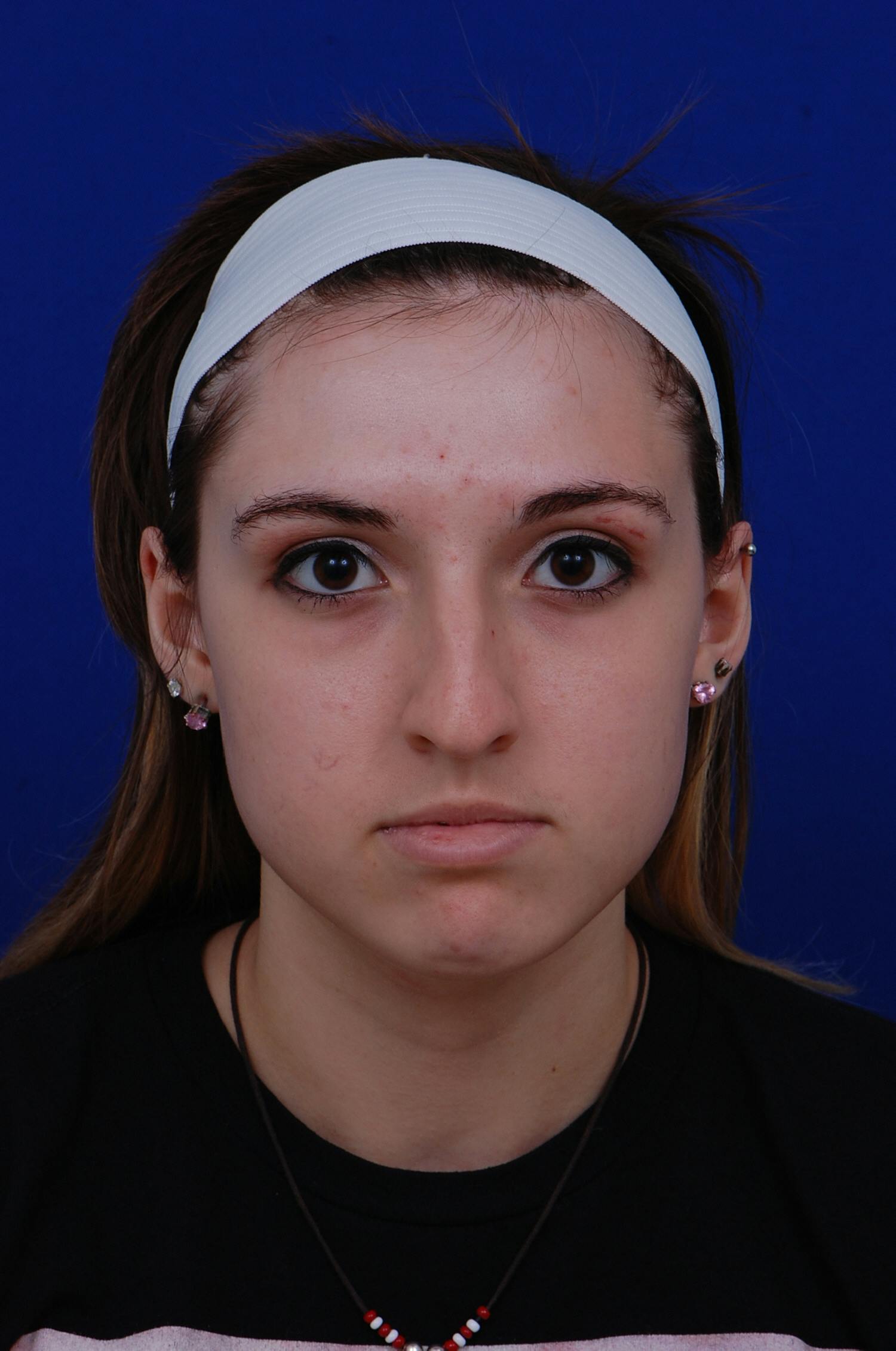 Rhinoplasty Before & After Gallery - Patient 14969404 - Image 5