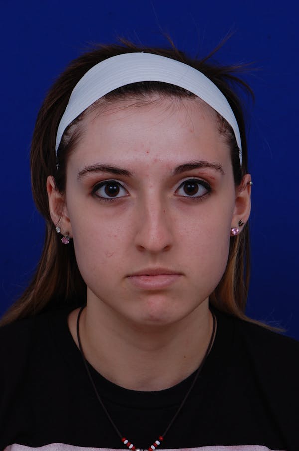 Rhinoplasty Before & After Gallery - Patient 14969404 - Image 5