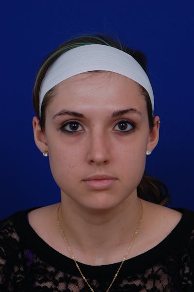 Rhinoplasty Before & After Gallery - Patient 14969404 - Image 6