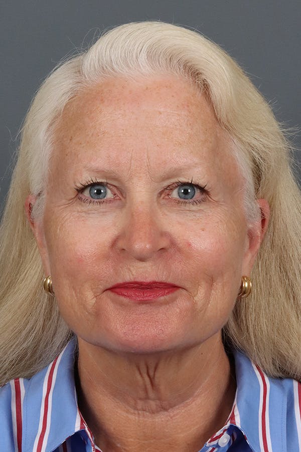 Facelift Before & After Gallery - Patient 882538 - Image 3