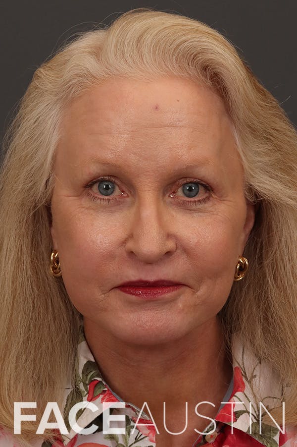 Facelift Before & After Gallery - Patient 882538 - Image 4