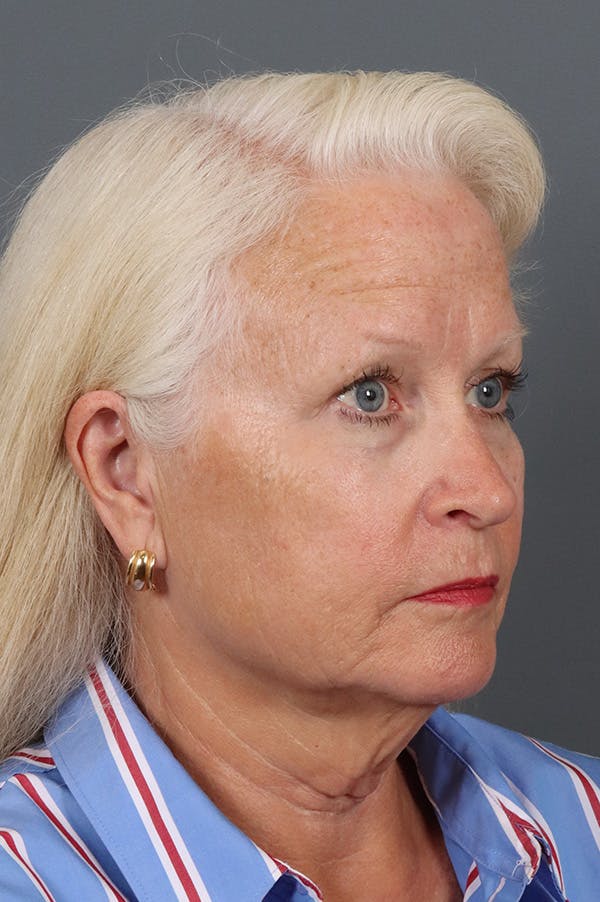 Facelift Before & After Gallery - Patient 882538 - Image 1