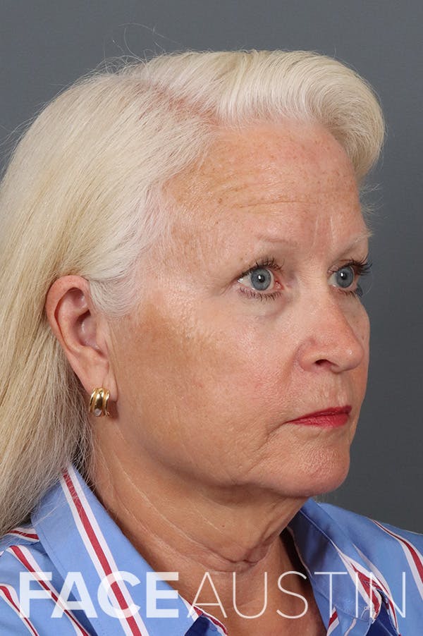 Facelift Before & After Gallery - Patient 882538 - Image 1