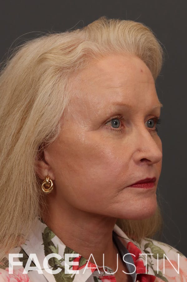 Facelift Before & After Gallery - Patient 882538 - Image 2