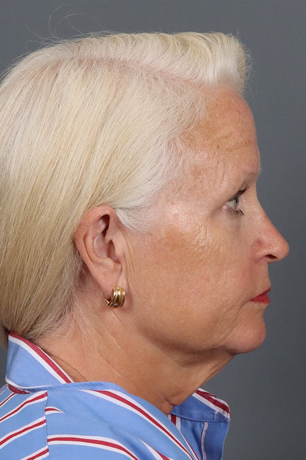 Facelift Before & After Gallery - Patient 882538 - Image 5