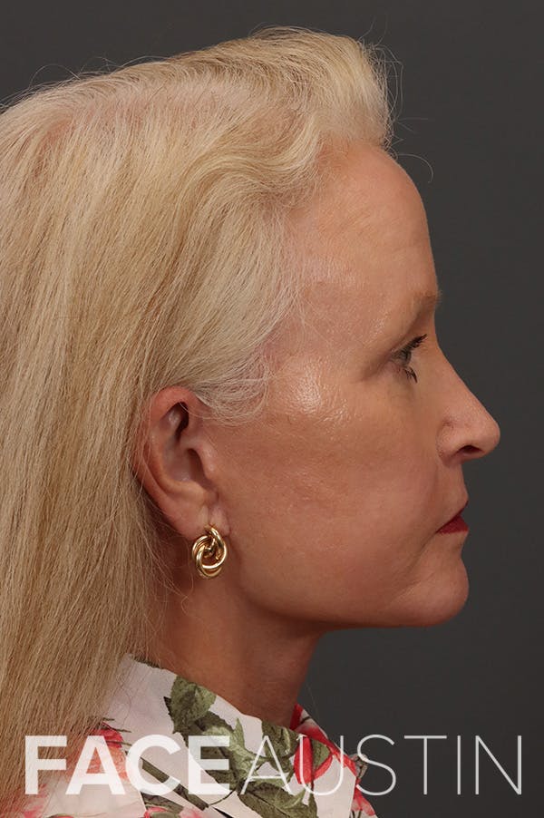 Facelift Before & After Gallery - Patient 882538 - Image 6