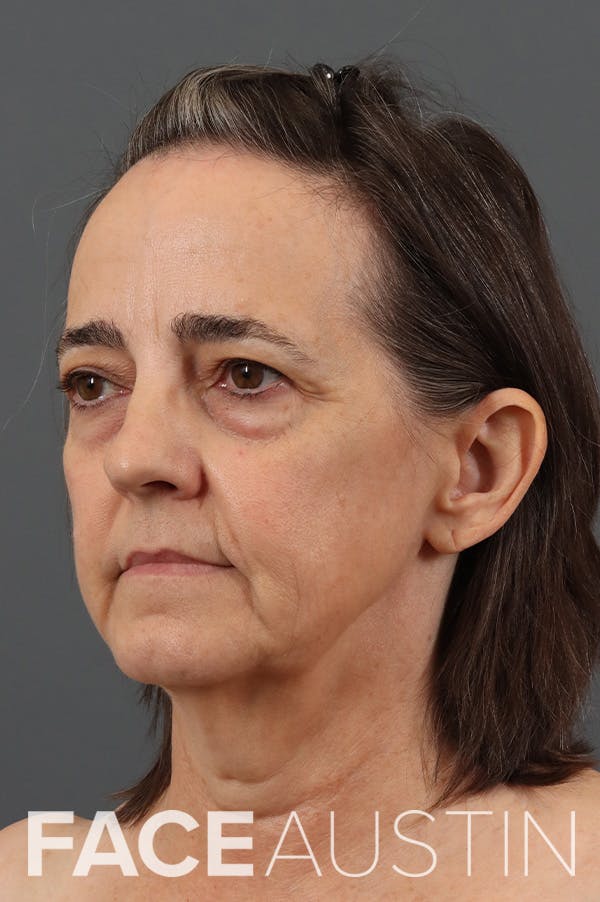 Facelift Before & After Gallery - Patient 326759 - Image 1